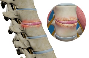 Spinal Infection